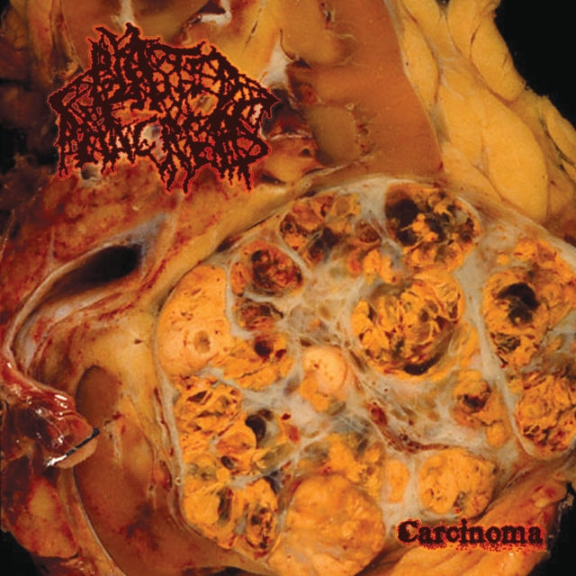 BLASTED PANCREAS | CARCINOMA | VINYL RECORD (LP)